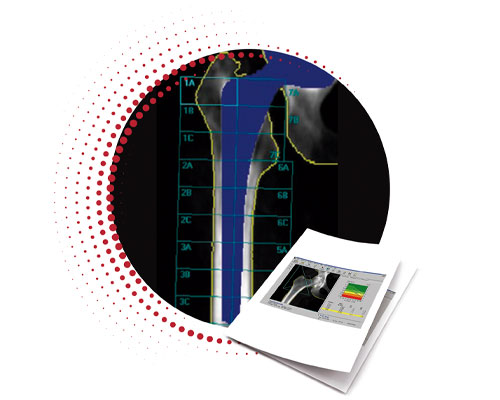 Densitometria de  Prótese de Quadril