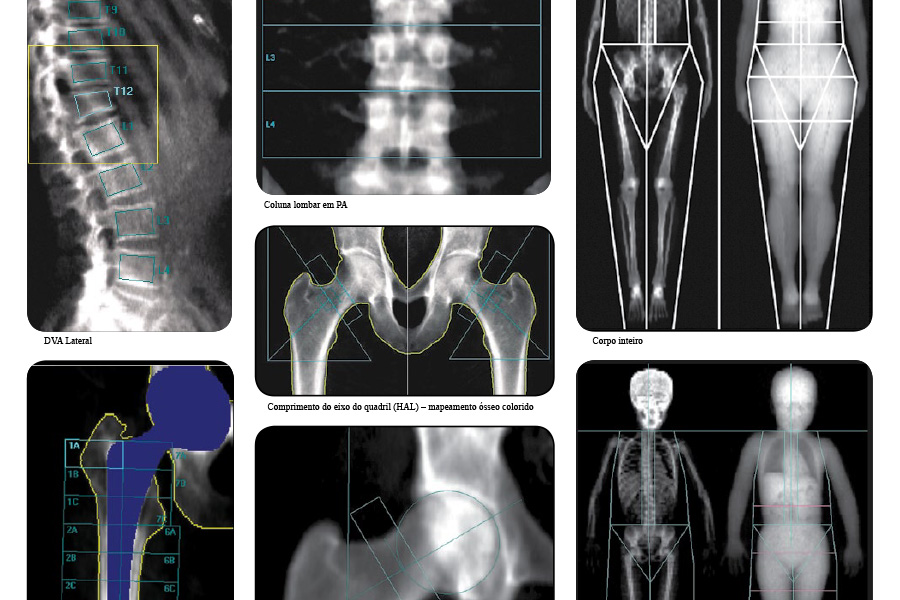 Densitometria Óssea