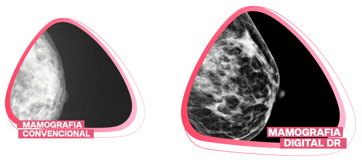 Comparativo Mamografia Digital