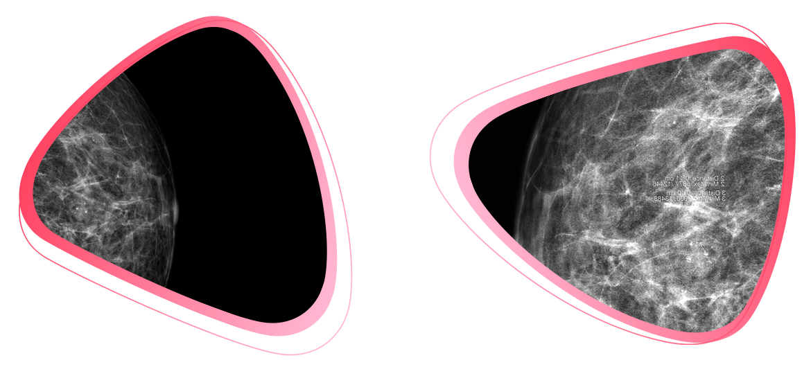 Mamografia Digital HR - Mais detalhes na Visualização.